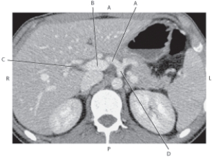 <strong>Questions 32 through 35 refer to the figure below of an axial CT of the abdomen. Which arrow points to the common hepatic artery?</strong> A) A B) B C) C D) D