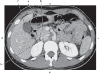 <strong>Questions 36 through 39 refer to the figure below of an axial CT of the abdomen. Which arrow points to the head of the pancreas?</strong> A) A B) B C) C D) D