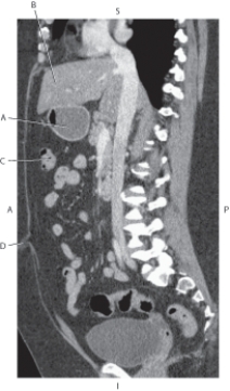 <strong>Questions 40 through 43 refer to the figure below of a sagittal CT reformat of the pancreas and IVC. Which arrow points to the stomach?</strong> A) A B) B C) C D) D