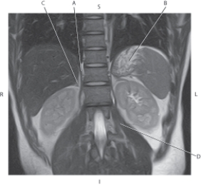 <strong>Questions 44 through 47 refer to the figure below. Which arrow points to the left psoas muscle?</strong> A) A B) B C) C D) D