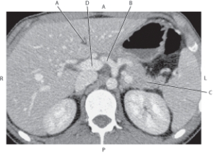 <strong>Questions 48 through 51 refer to the figure below. Which arrow is pointing to the tail of the pancreas?</strong> A) A B) B C) C D) D