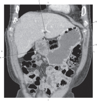 <strong>Questions 52 through 55 refer to the figure below. Which arrow points to the pyloric sphincter?</strong> A) A B) B C) C D) D