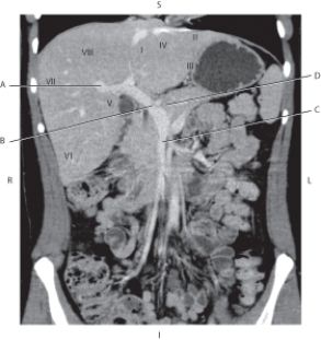 <strong>Questions 56 through 59 refer to the figure below. Which arrow points to the main portal vein?</strong> A) A B) B C) C D) D