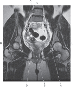 <strong>Questions 13 through 16 refer to the figure below of a coronal MRI of the female pelvis. Which arrow points to the uterosacral ligament?</strong> A) A B) B C) C D) D