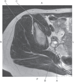 <strong>Questions 18 through 21 refer to the figure below of an axial MRI of the female pelvis. Which arrow points to the ovary?</strong> A) A B) B C) C D) D