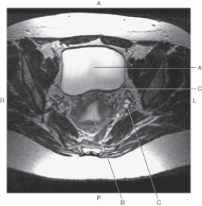 <strong>Questions 18 through 21 refer to the figure below of an axial MRI of the female pelvis. In the figure below of an axial MRI of the female pelvis,which arrow points to the left ovary? </strong> A) A B) B C) C D) D