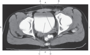 <strong>Questions 18 through 21 refer to the figure below of an axial MRI of the female pelvis. In the figure below of an axial CT of the male pelvis,which arrow points to the seminal vesicle? </strong> A) A B) B C) C D) D