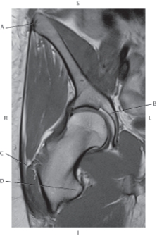 <strong>Questions 24 through 27 refer to the figure below. Which arrow points to the acetabulum?</strong> A) A B) B C) C D) D
