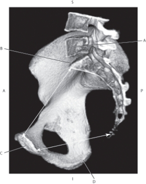<strong>Questions 28 through 31 refer to the figure below of a 3D CT of the pelvis. Which arrow points to the pubic symphysis?</strong> A) A B) B C) C D) D