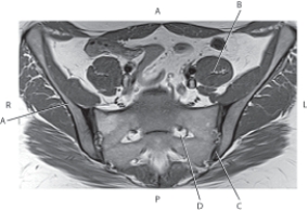 <strong>Questions 32 through 35 refer to the figure below of an axial, T1-weighted MRI of the ilium and sacroiliac joints. Which arrow points to the ilium?</strong> A) A B) B C) C D) D