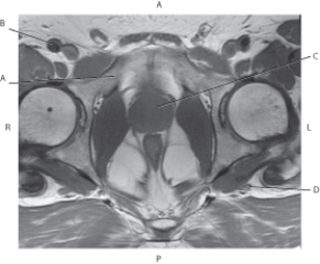 <strong>Questions 36 through 39 refer to the figure below of an axial, T1-weighted MRI of the male pelvis. Which arrow points to the sciatic nerve?</strong> A) A B) B C) C D) D