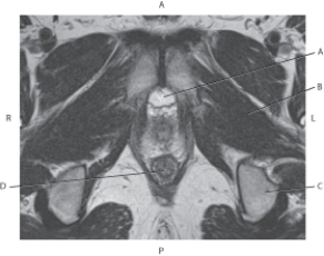 <strong>Questions 40 through 43 refer to the figure below of an axial, T2-weighted MRI of the male pelvis. Which arrow points to the retropubic space?</strong> A) A B) B C) C D) D
