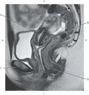 <strong>Questions 44 through 47 refer to the figure below of a sagittal, T2-weighted MRI of the female pelvis. Which arrow points to the pubic symphysis?</strong> A) A B) B C) C D) D