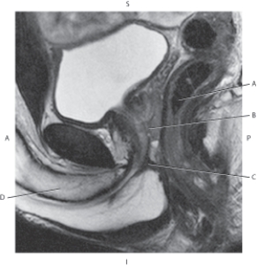 <strong>Questions 48 through 51 refer to the figure below of a sagittal, T2-weighted MRI of the male pelvis. Which arrow points to the rectum?</strong> A) A B) B C) C D) D
