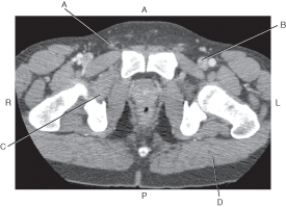 <strong>Questions 52 through 55 refer to the figure below of an axial CT of the male pelvis. Which arrow points to the gluteus maximus muscle?</strong> A) A B) B C) C D) D