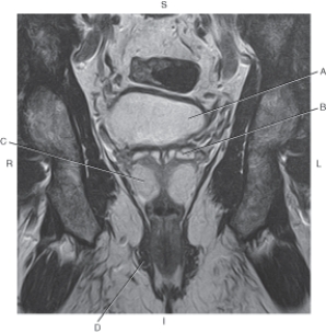 <strong>Questions 56 through 59 refer to the figure below of a coronal, T2-weighted MRI of the male pelvis. Which arrow points to the bladder?</strong> A) A B) B C) C D) D