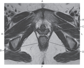 <strong>Questions 60 through 63 refer to the figure below of an axial, T2-weighted MRI of a female pelvis. Which arrow points to the urethra?</strong> A) A B) B C) C D) D