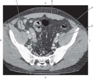 <strong>Questions 64 through 67 refer to the figure below of an axial CT of the pelvis. Which arrow points to the external iliac artery?</strong> A) A B) B C) C D) D