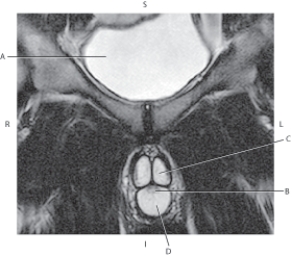 <strong>Questions 68 through 71 refer to the figure below of a coronal, T2-weighted MRI of the penis. Which arrow points to the corpus cavernosum?</strong> A) A B) B C) C D) D