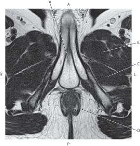 <strong>Questions 72 through 75 refer to the figure below of an axial, T2-weighted MRI of the male pelvis. Which arrow points to the levator ani muscle?</strong> A) A B) B C) C D) D