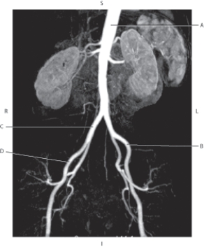 <strong>Questions 76 through 79 refer to the figure below of an MRA of the descending aorta. Which arrow points to the right common iliac artery?</strong> A) A B) B C) C D) D