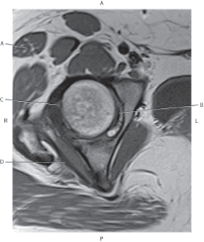 <strong>Questions 80 through 83 refer to the figure below of an axial, T1-weighted MRI of the right hip. Which arrow points to the tensor fascia latae muscle?</strong> A) A B) B C) C D) D