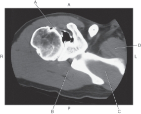 <strong>In the figure below of an axial CT of the shoulder,which arrow points to the subscapularis muscle? </strong> A) A B) B C) C D) D