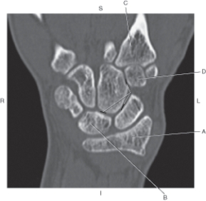 <strong>Questions 18 through 21 refer to the figure below of a coronal CT reformat of the wrist. Which arrow points to the second metacarpal?</strong> A) A B) B C) C D) D