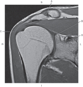<strong>Questions 22 through 25 refer to the figure below. Which arrow points to the deltoid muscle?</strong> A) A B) B C) C D) D