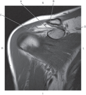 <strong>Questions 26 through 29 refer to the figure below of a sagittal oblique, T1-weighted MRI of the shoulder. Which arrow points to the coracoid process?</strong> A) A B) B C) C D) D