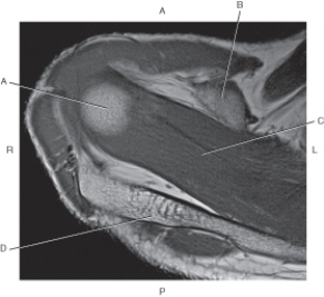 <strong>Questions 30 through 33 refer to the figure below of a coronal oblique, T1-weighted MRI of the right shoulder. Which arrow points to the coracoid process?</strong> A) A B) B C) C D) D