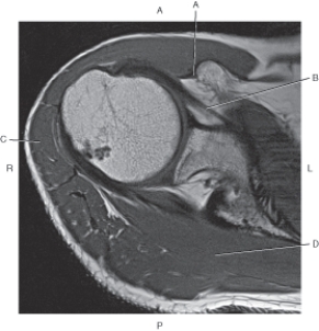 <strong>Questions 34 through 37 refer to the figure below of an axial, T1-weighted MRI of the right shoulder. Which arrow points to the supraspinatus muscle?</strong> A) A B) B C) C D) D
