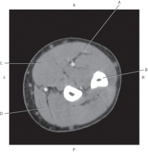 <strong>Questions 38 through 41 refer to the figure below of an axial, T1-weighted MRI of the right shoulder. Which arrow points to the deltoid muscle?</strong> A) A B) B C) C D) D