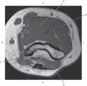 <strong>Questions 42 through 45 refer to the figure below of an axial CT of the right forearm. Which arrow points to the flexor digitorum superficialis muscle?</strong> A) A B) B C) C D) D
