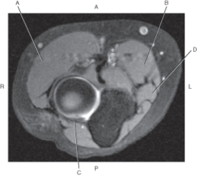 <strong>Questions 46 through 49 refer to the figure below of an axial, T1-weighted MRI of the distal humerus. Which arrow points to the ulnar nerve?</strong> A) A B) B C) C D) D