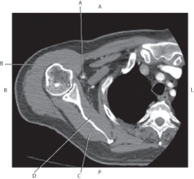 <strong>Questions 50 through 53 refer to the figure below of an axial, T2-weighted MRI of the elbow. Which arrow points to the flexor digitorum superficialis muscle?</strong> A) A B) B C) C D) D