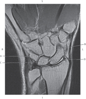 <strong>Questions 54 through 57 refer to the figure below of an axial CT of the right shoulder. Which arrow points to the infraspinatus muscle?</strong> A) A B) B C) C D) D