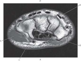 <strong>Questions 58 through 61 refer to the figure below of a coronal, T2-weighted MRI of the wrist. Which arrow points to the midcarpal joint?</strong> A) A B) B C) C D) D