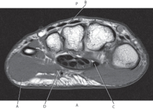 <strong>Questions 62 through 65 refer to the figure below of an axial, T1-weighted MRI of the wrist. Which arrow points to the abductor digiti minimi muscle?</strong> A) A B) B C) C D) D