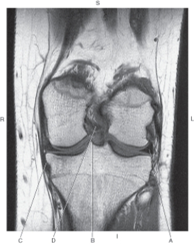 <strong>In the figure below of a coronal MR of the knee,which arrow points to the posterior cruciate ligament? </strong> A) A B) B C) C D) D