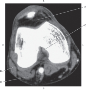 <strong>Questions 21 through 24 refer to the figure below of an axial CT of the knee. Which arrow points to the posterior cruciate ligament?</strong> A) A B) B C) C D) D