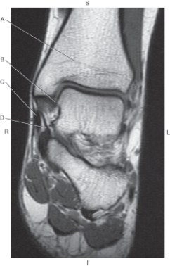 <strong>Questions 21 through 24 refer to the figure below of an axial CT of the knee. In the figure below of a coronal MR of the ankle,which arrow points to the tibiotalar ligament? </strong> A) A B) B C) C D) D