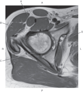 <strong>Questions 26 through 29 refer to the figure below of an axial, T1-weighted MRI of the right hip. Which arrow is pointing to the ligamentum teres?</strong> A) A B) B C) C D) D