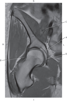 <strong>Questions 30 through 32 refer to the figure below of a coronal, T1-weighted MRI of the right hip. Which arrow is pointing to the acetabulum?</strong> A) A B) B C) C D) D