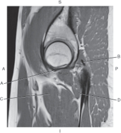 <strong>Questions 33 through 36 refer to the figure below of a sagittal, T1-weighted MRI of the hip. Which arrow is pointing to the pectineus muscle?</strong> A) A B) B C) C D) D