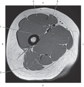 <strong>Questions 37 through 40 refer to the figure below of an axial, T1-weighted MRI of the right proximal femur. Which arrow is pointing to the sartorius muscle?</strong> A) A B) B C) C D) D