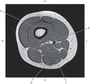 <strong>Questions 41 through 44 refer to the figure below of an axial, T1-weighted MRI of the right distal femur. Which arrow is pointing to the semimembranosus muscle?</strong> A) A B) B C) C D) D