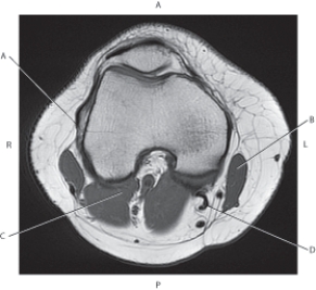 <strong>Questions 45 through 48 refer to the figure below of an axial, T1-weighted MRI of the distal right femur. Which arrow is pointing to the semimembranosus tendon?</strong> A) A B) B C) C D) D