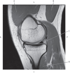 <strong>Questions 49 through 52 refer to the figure below of a sagittal, T1-weighted MRI of the knee. Which arrow is pointing to the oblique popliteal ligament?</strong> A) A B) B C) C D) D