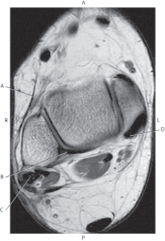 <strong>Questions 53 through 56 refer to the figure below of an axial, T1-weighted image of the right ankle. Which arrow is pointing to the flexor digitorum longus tendon?</strong> A) A B) B C) C D) D
